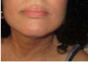 electrolysis case study - 4 days post treatment
