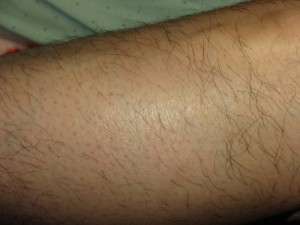 post inflammatory hyperpigmentation commonly follows effective electrolysis treatment of the body