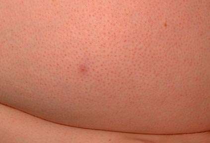 Inflamed hair follicles can be improved by electrolyis hair removal