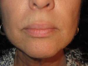 electrolysis case study - vivian after treatment on the chin and upper lip