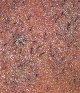 electrolysis and black skin-hyperpigmentation evident as a result of coarse hair growth under chin