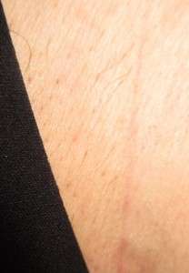Electrolysis Case Study - Bikini line 3 months following treatment with electrolysis hair removal