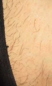 electrolysis case study - bikini line prior to electrolysis treatment