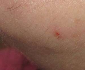 Electrolysis Case Study - Coarse Chin Hair