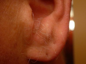 electrolysis treatment area - ear