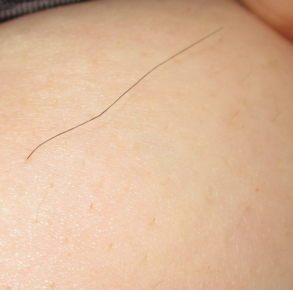 Electrolysis treatment area - breast