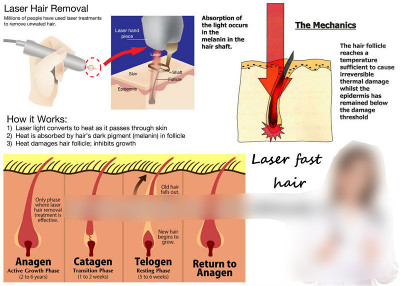 How Does Laser Hair Removal Work? - Follikill Permanent Hair Removal