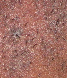 electrolysis and black skin-hyperpigmentation evident as a result of coarse hair growth under chin
