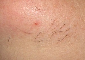 coarse hair on female chin prior to electrolysis permanent hair removal