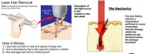 Illustration showing how laser hair removal work