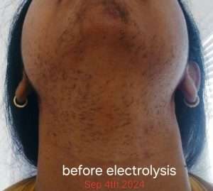 image of brown woman with lots of dark hair and hyperpigmentation.