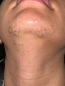 electrolysis treatment time for face