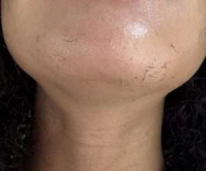 Chin after several hours of electrolysis