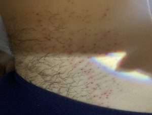 Close up image of a half-treated bikini line 