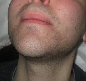Image of full male beard prior to electrolsis