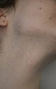 Male beard after one year of electrolysis