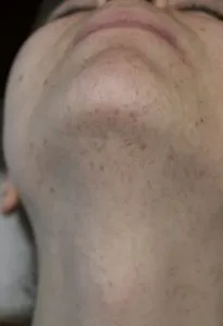 Male beard removal by electrolysis