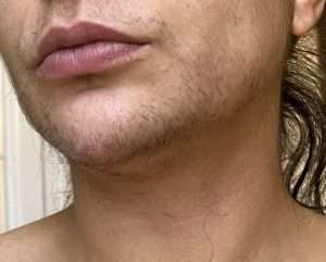 Typical female PCOS growth prior to electrolysis.